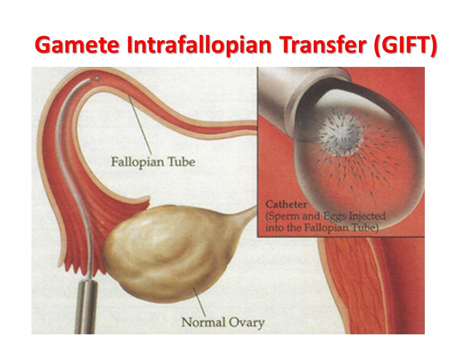 Infertility  GIFT