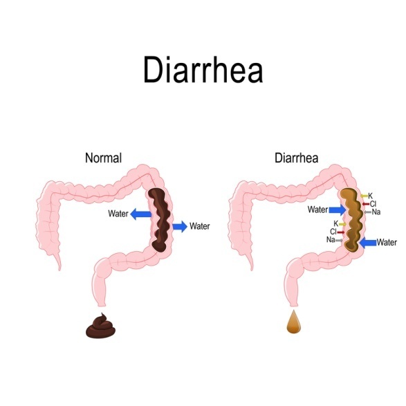 diarrhea-dreamstime_s_136912244.jpg