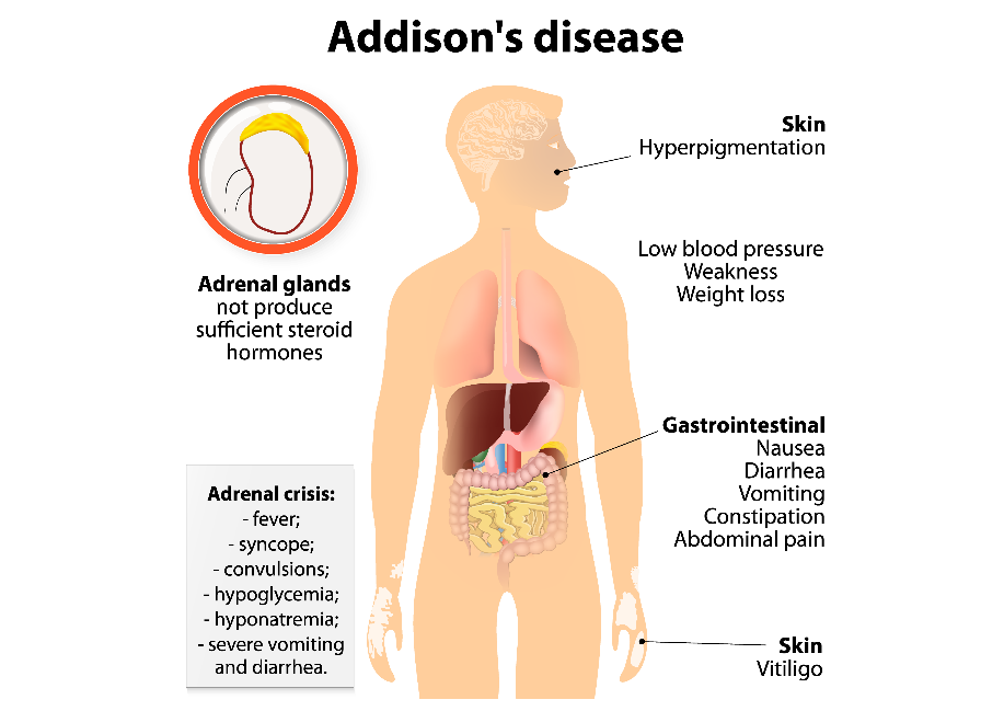 Image result for Addison's disease